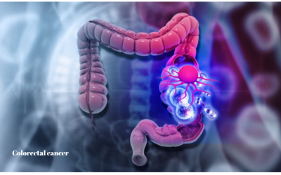 Colorectal cancer